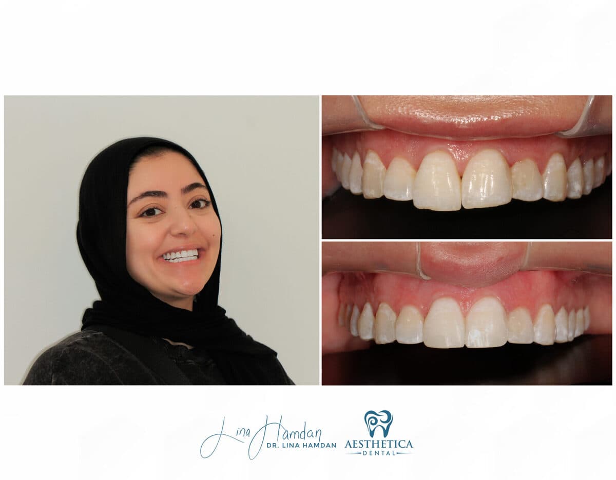 Clear aligners, quietly handled: anonymous case 62 from Aesthetica Dental Naperville