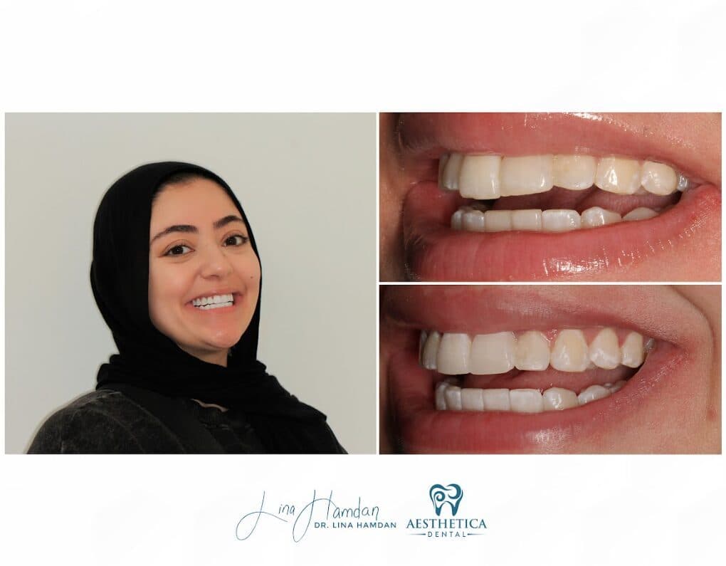 Clear aligners, quietly handled: anonymous case 64 from Aesthetica Dental Naperville