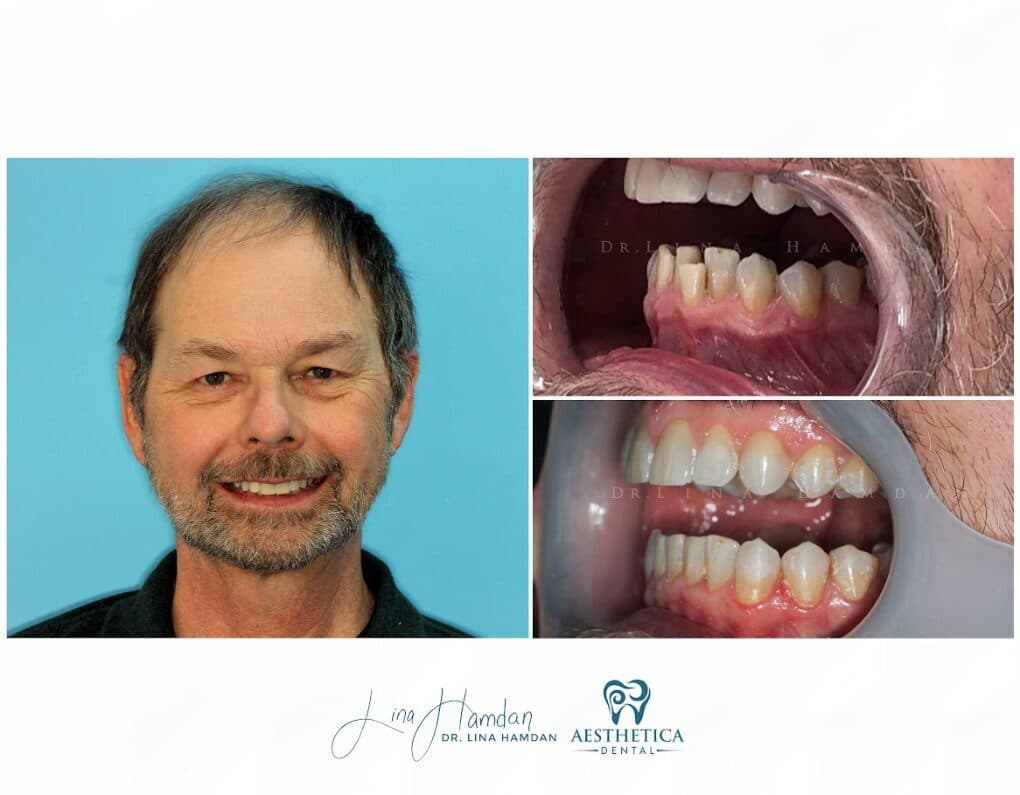 Clear aligners, quietly handled: anonymous case 67 from Aesthetica Dental Naperville
