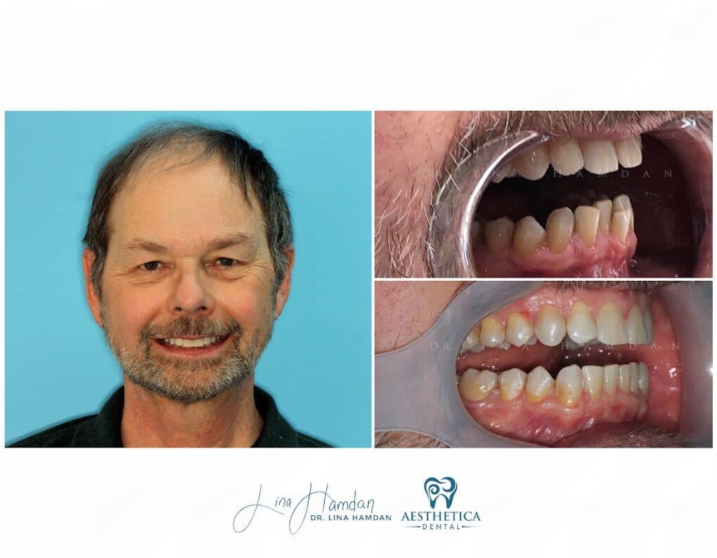 Clear aligners, quietly handled: anonymous case 68 from Aesthetica Dental Naperville