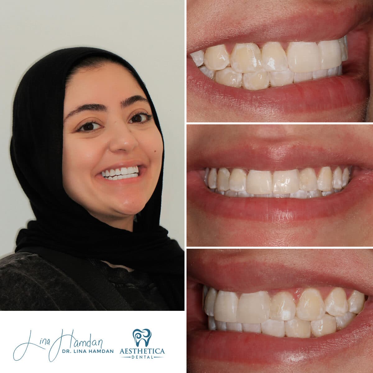 Clear aligners, quietly handled: anonymous case 72 from Aesthetica Dental Naperville