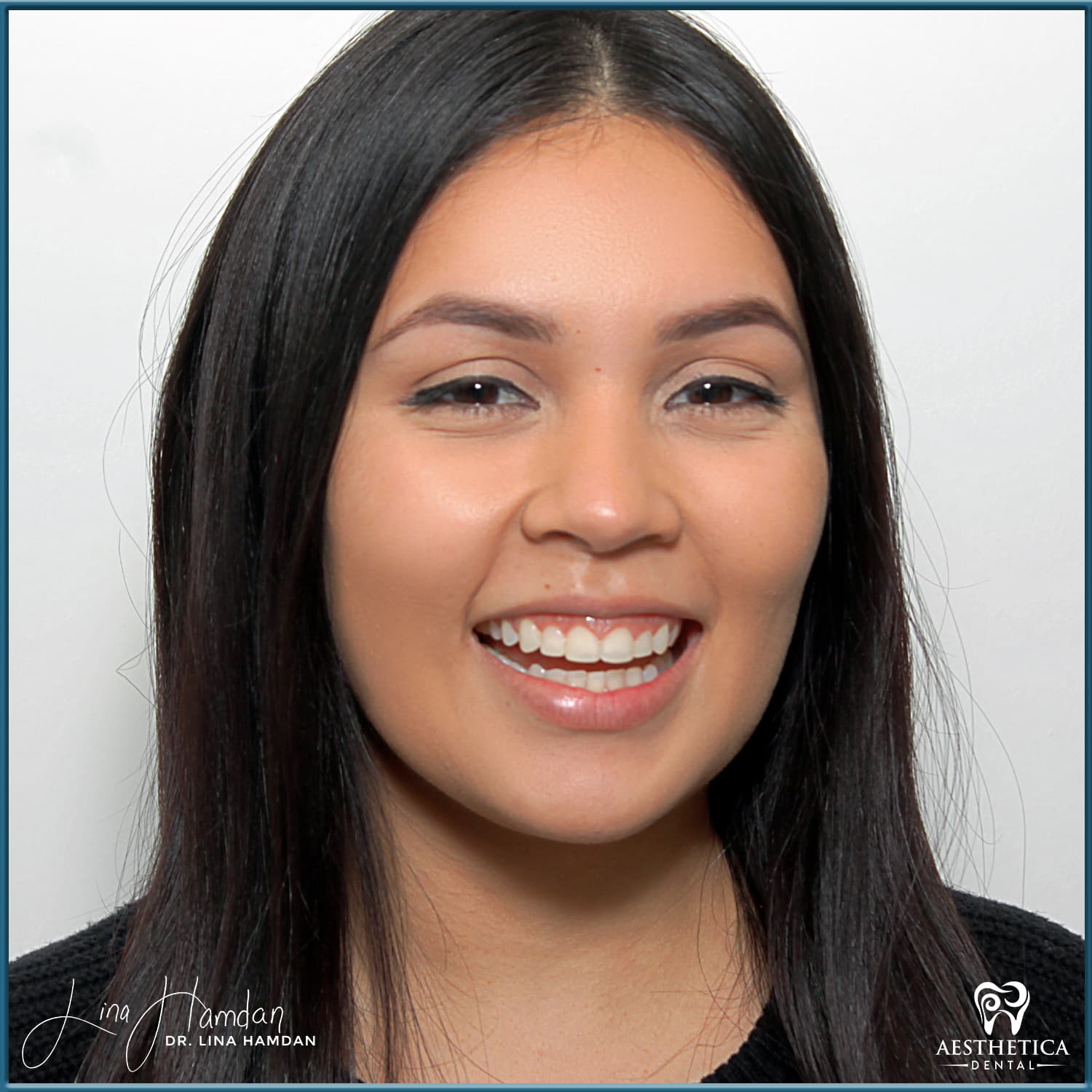 A full re-design of the smile: anonymous case 17 from Aesthetica Dental Naperville
