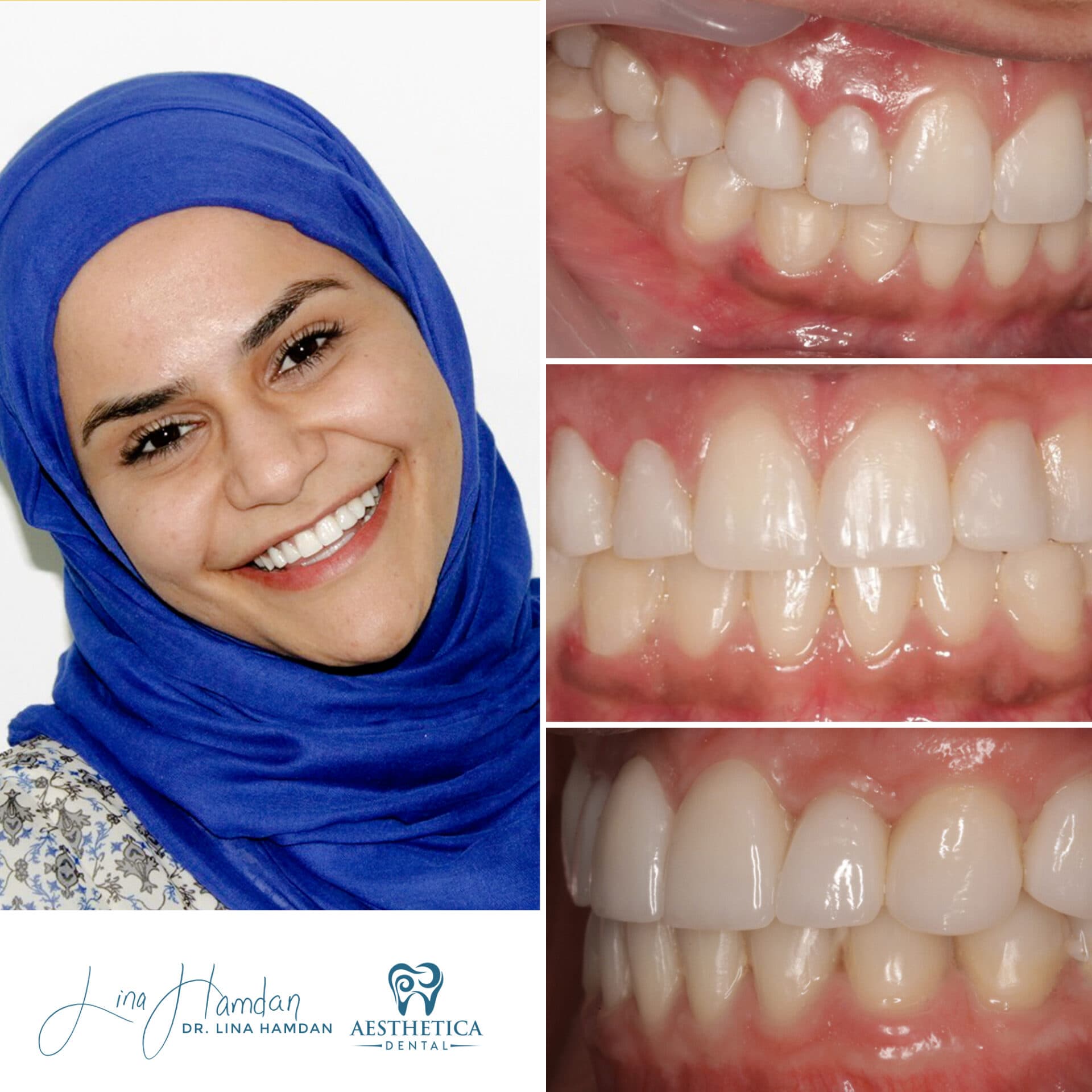 A full re-design of the smile: anonymous case 26 from Aesthetica Dental Naperville