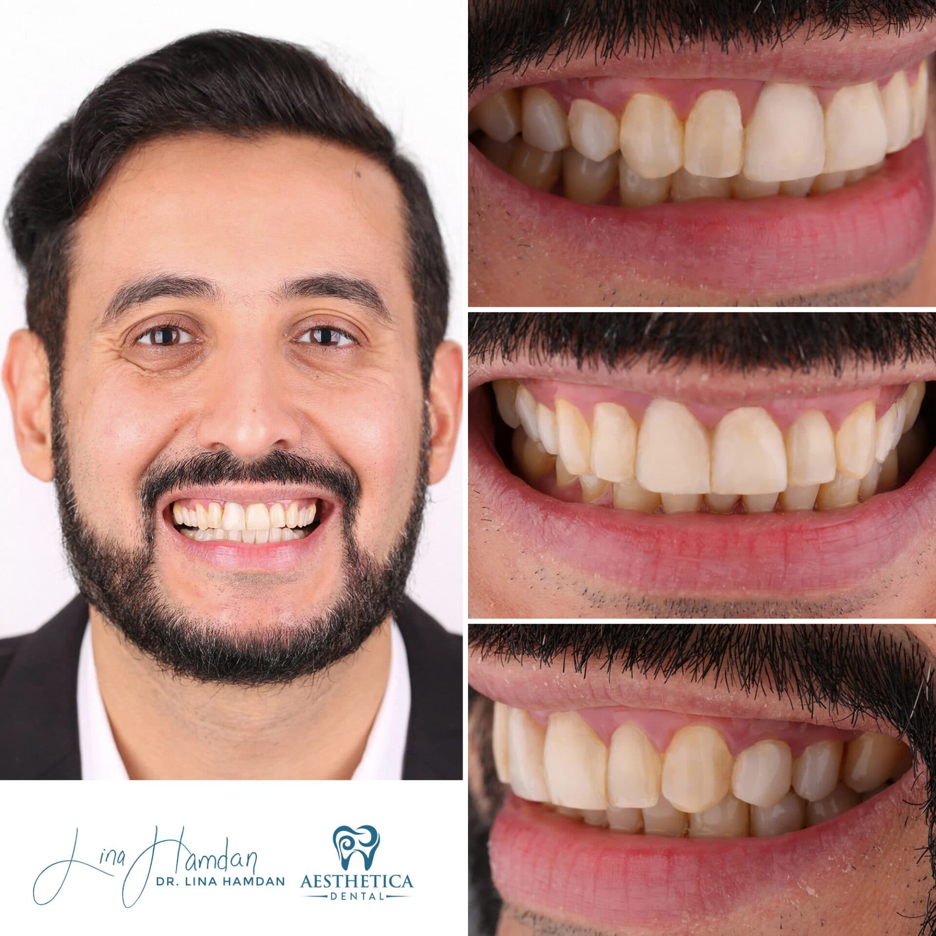 A full re-design of the smile: anonymous case 27 from Aesthetica Dental Naperville