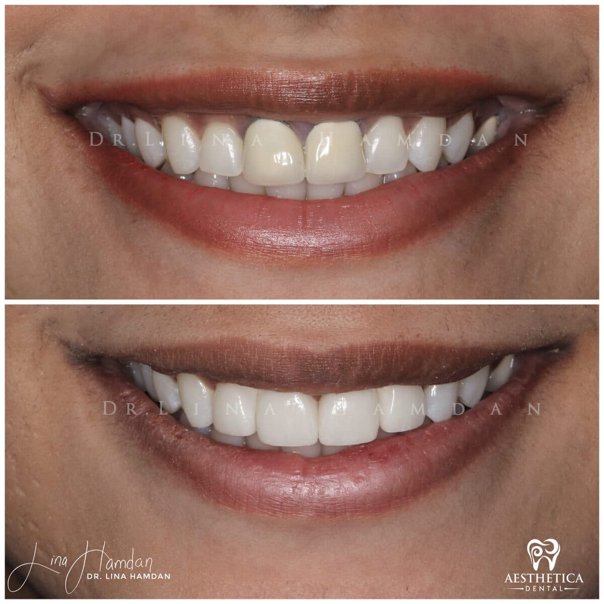 Considered porcelain veneers. — anonymous patient at Aesthetica Dental Naperville
