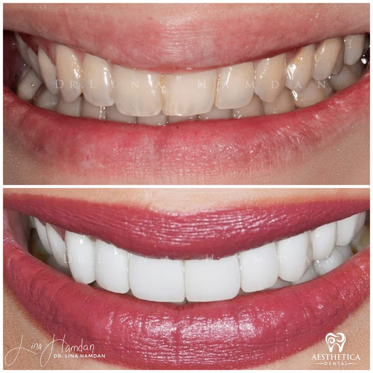 Porcelain veneers result, anonymous patient at Aesthetica Dental Naperville (case 2, 2025-01-1-11)