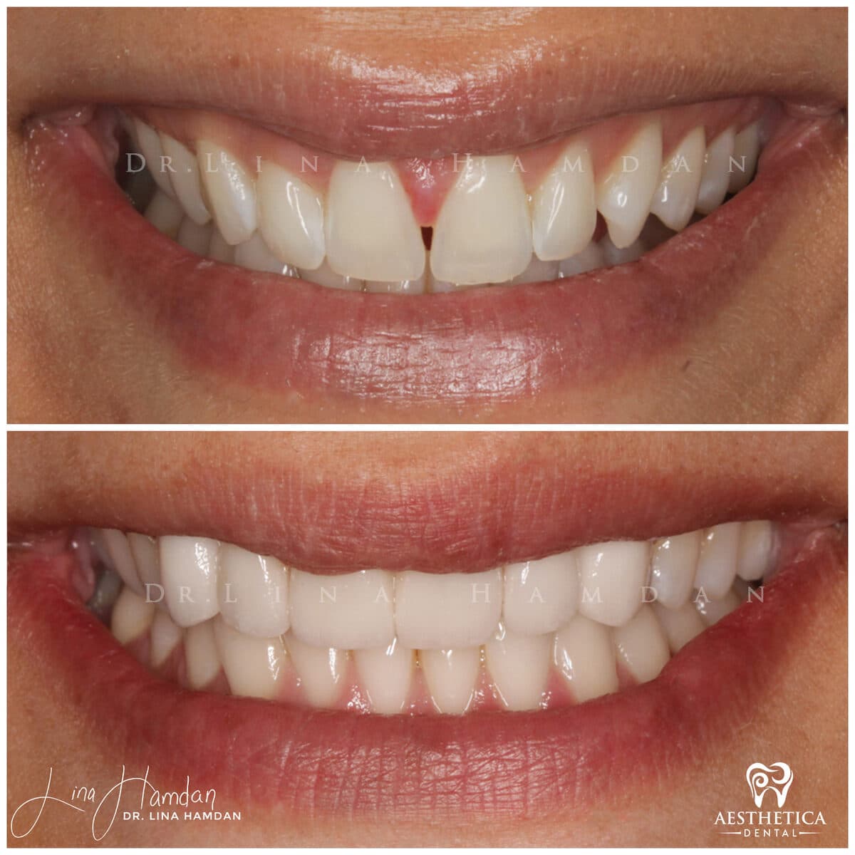 Porcelain veneers result, anonymous patient at Aesthetica Dental Naperville (case 5, 2025-01-1-14)