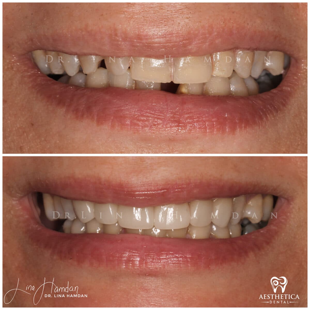 Porcelain veneers result, anonymous patient at Aesthetica Dental Naperville (case 6, 2025-01-1-15)