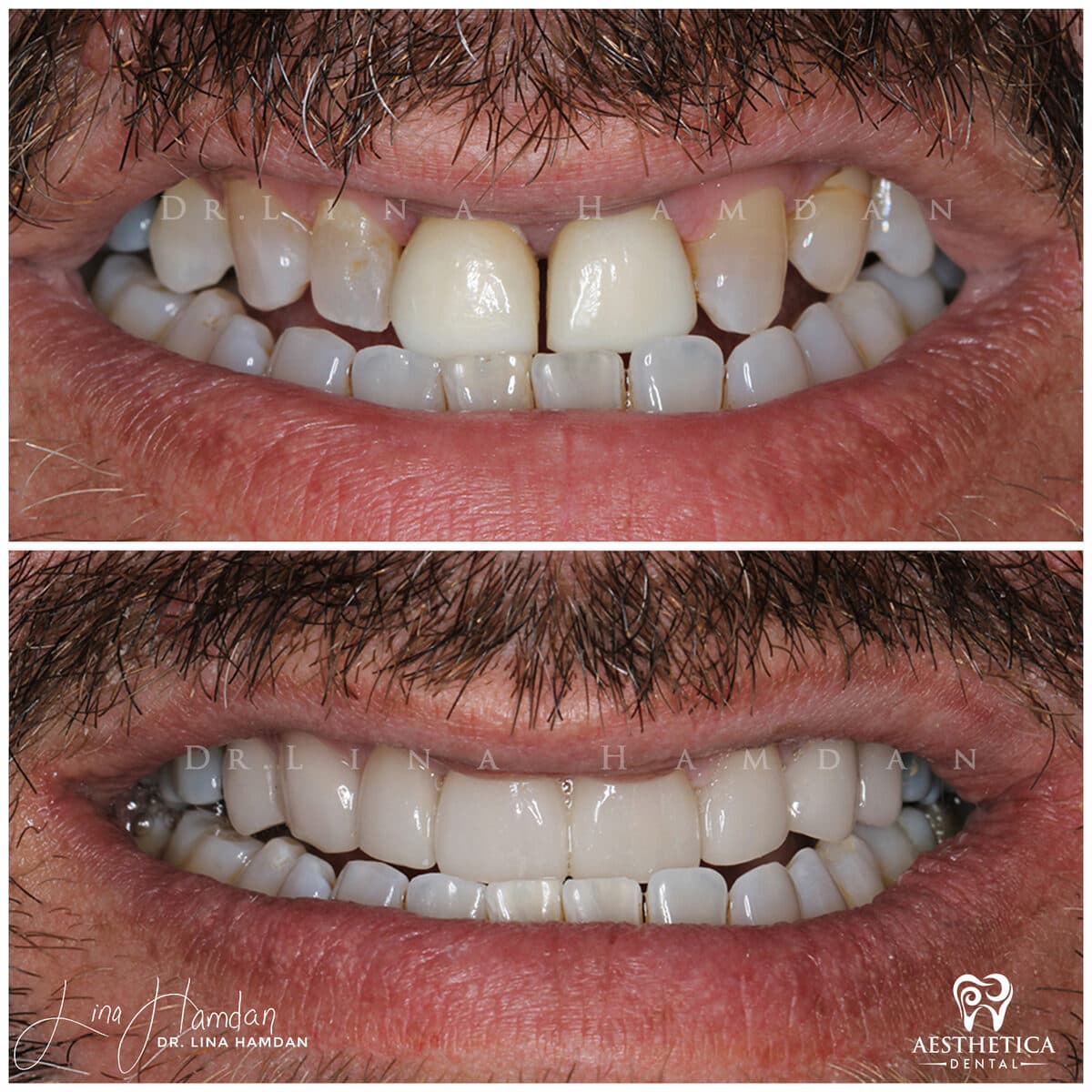 Porcelain veneers result, anonymous patient at Aesthetica Dental Naperville (case 7, 2025-01-1-16)