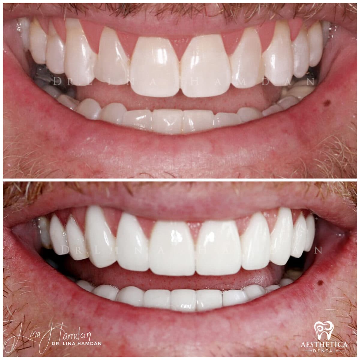 Porcelain veneers result, anonymous patient at Aesthetica Dental Naperville (case 9, 2025-01-1-18)