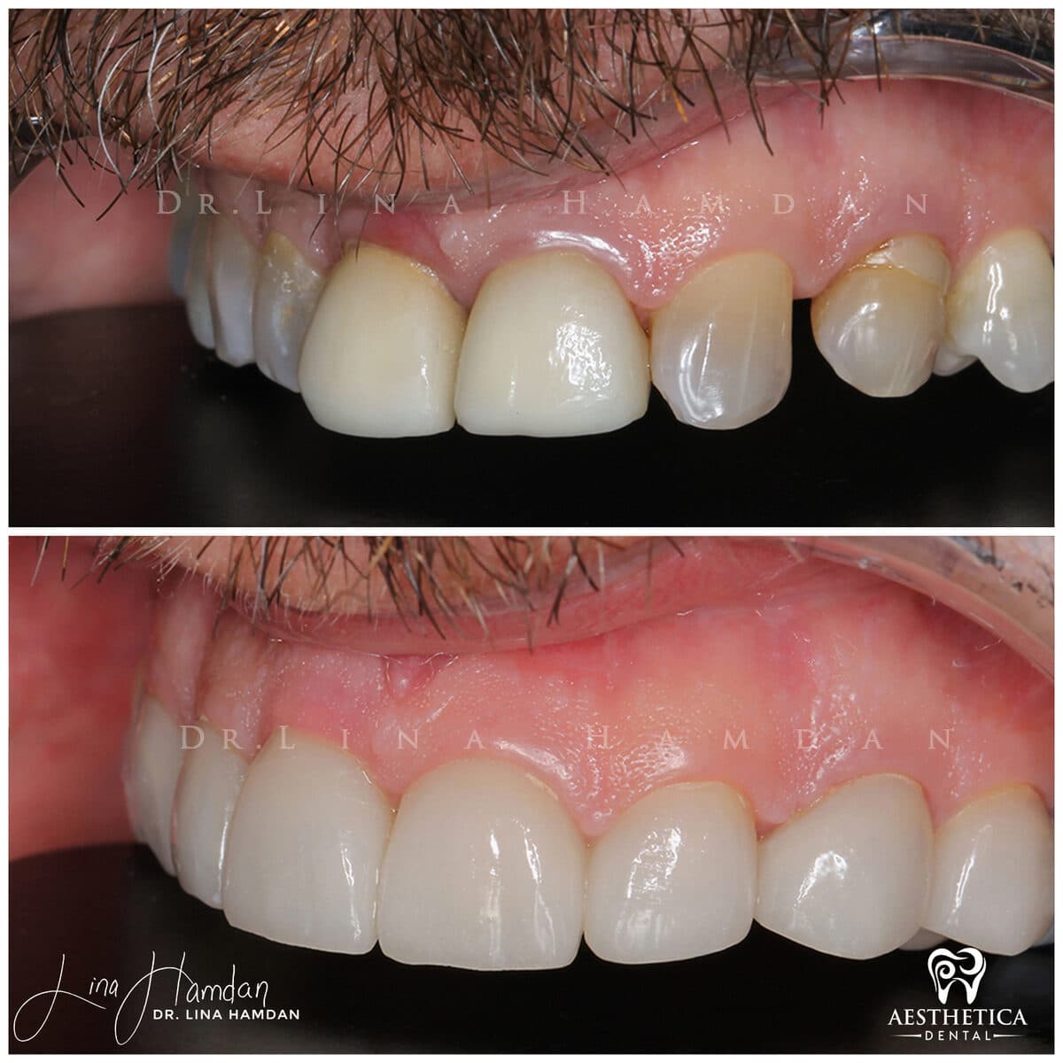 Porcelain veneers result, anonymous patient at Aesthetica Dental Naperville (case 12, 2025-01-10-8)