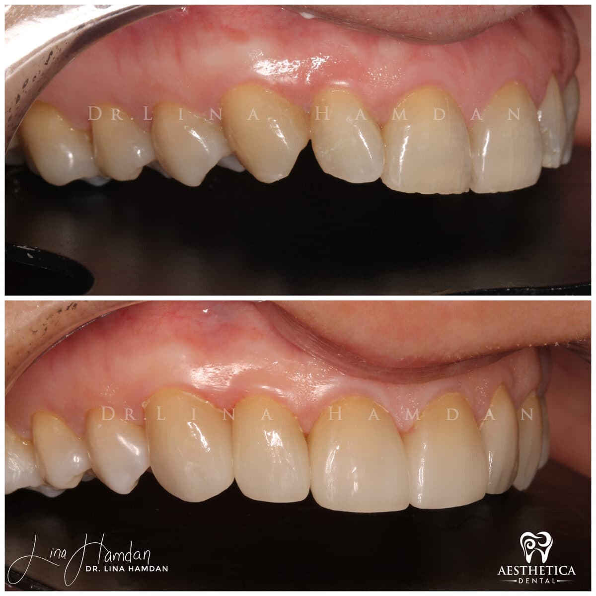 Considered porcelain veneers: anonymous case 16 from Aesthetica Dental Naperville