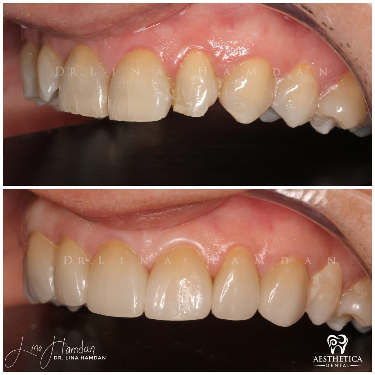 Considered porcelain veneers: anonymous case 18 from Aesthetica Dental Naperville
