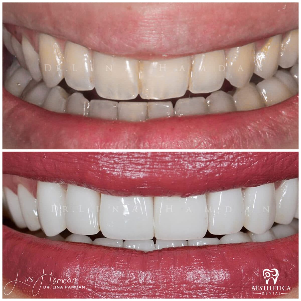 Considered porcelain veneers: anonymous case 22 from Aesthetica Dental Naperville