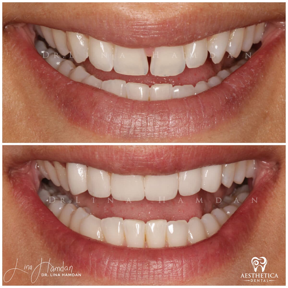 Considered porcelain veneers: anonymous case 25 from Aesthetica Dental Naperville