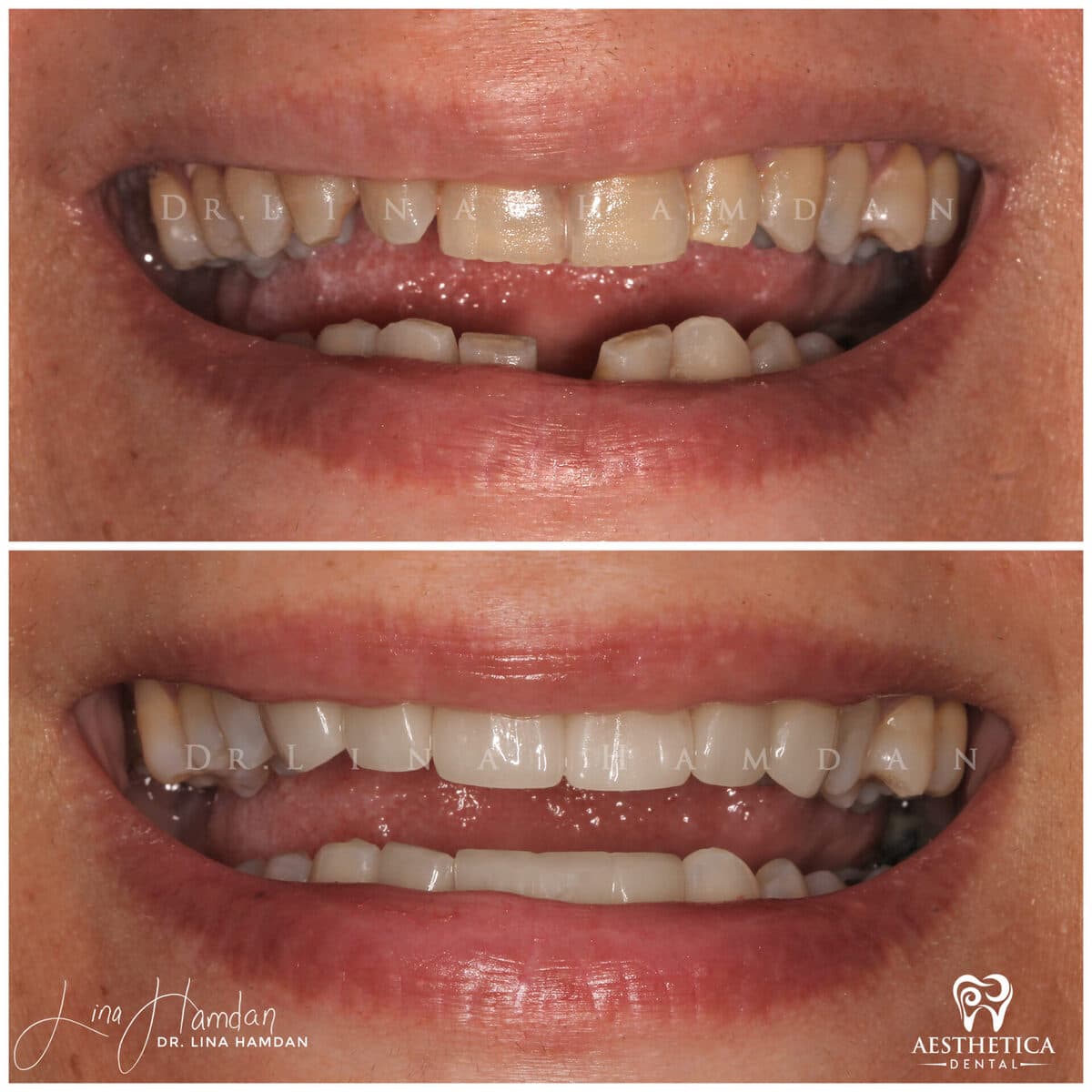 Considered porcelain veneers: anonymous case 26 from Aesthetica Dental Naperville
