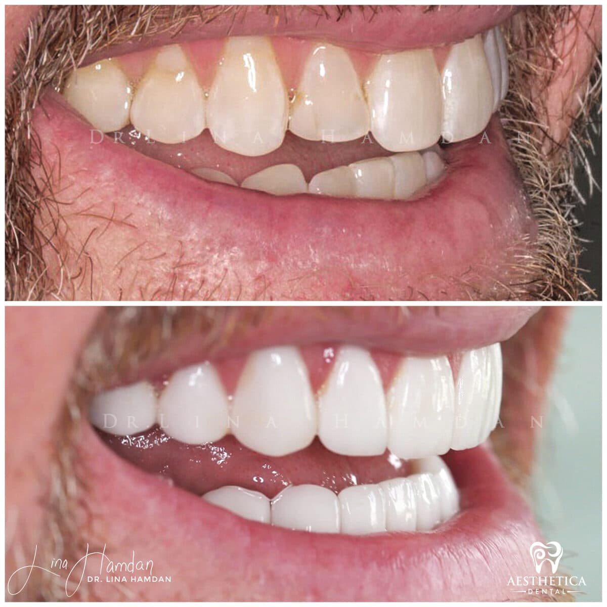 Considered porcelain veneers: anonymous case 28 from Aesthetica Dental Naperville