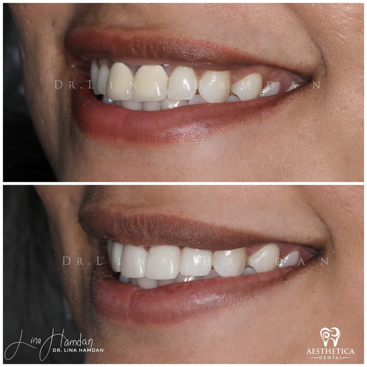 Considered porcelain veneers: anonymous case 31 from Aesthetica Dental Naperville
