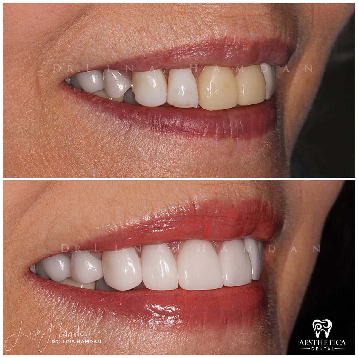 Considered porcelain veneers: anonymous case 33 from Aesthetica Dental Naperville