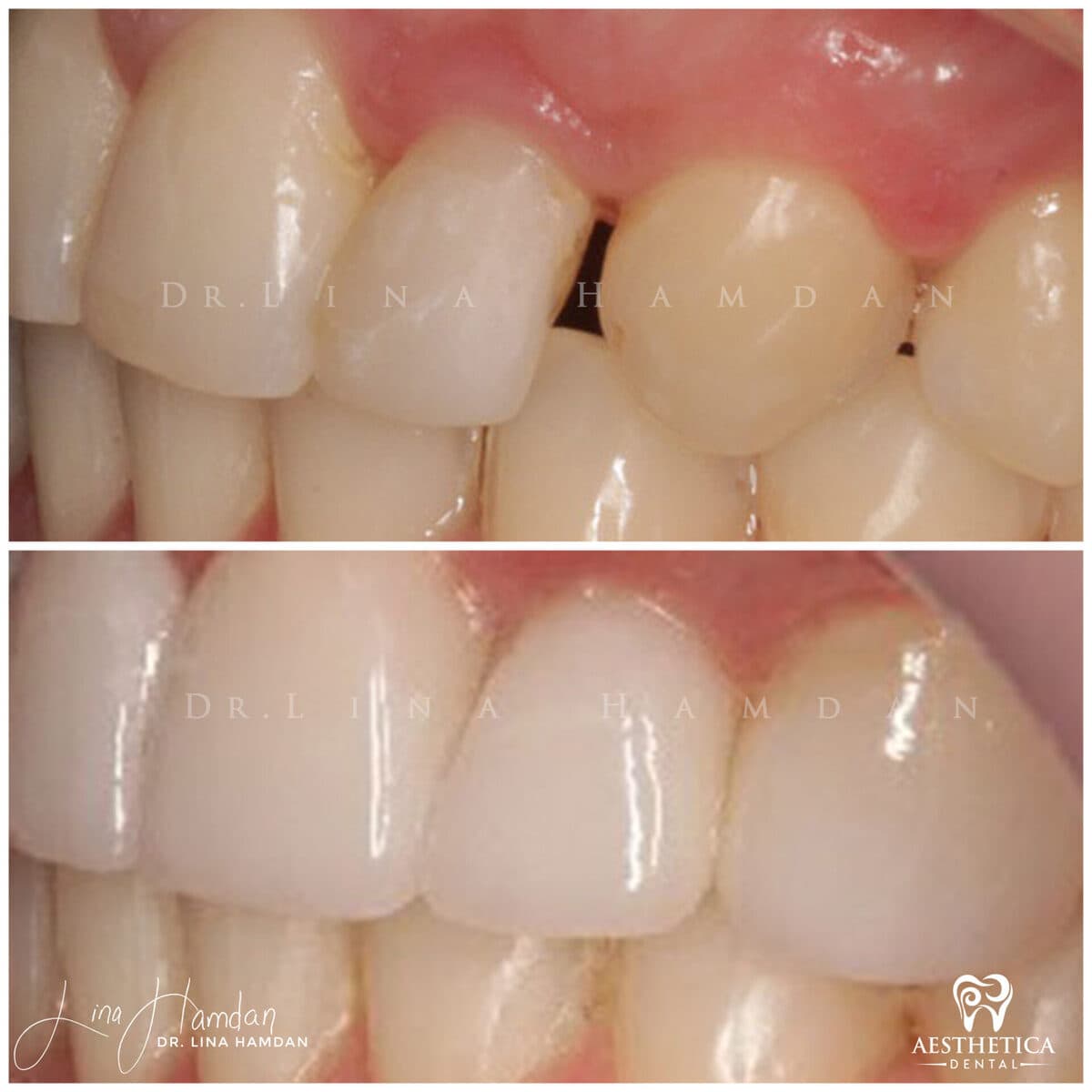 Considered porcelain veneers: anonymous case 35 from Aesthetica Dental Naperville
