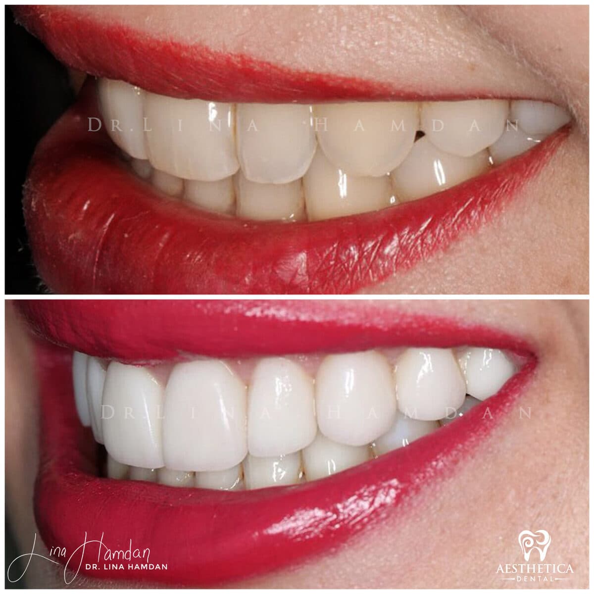 Considered porcelain veneers: anonymous case 37 from Aesthetica Dental Naperville