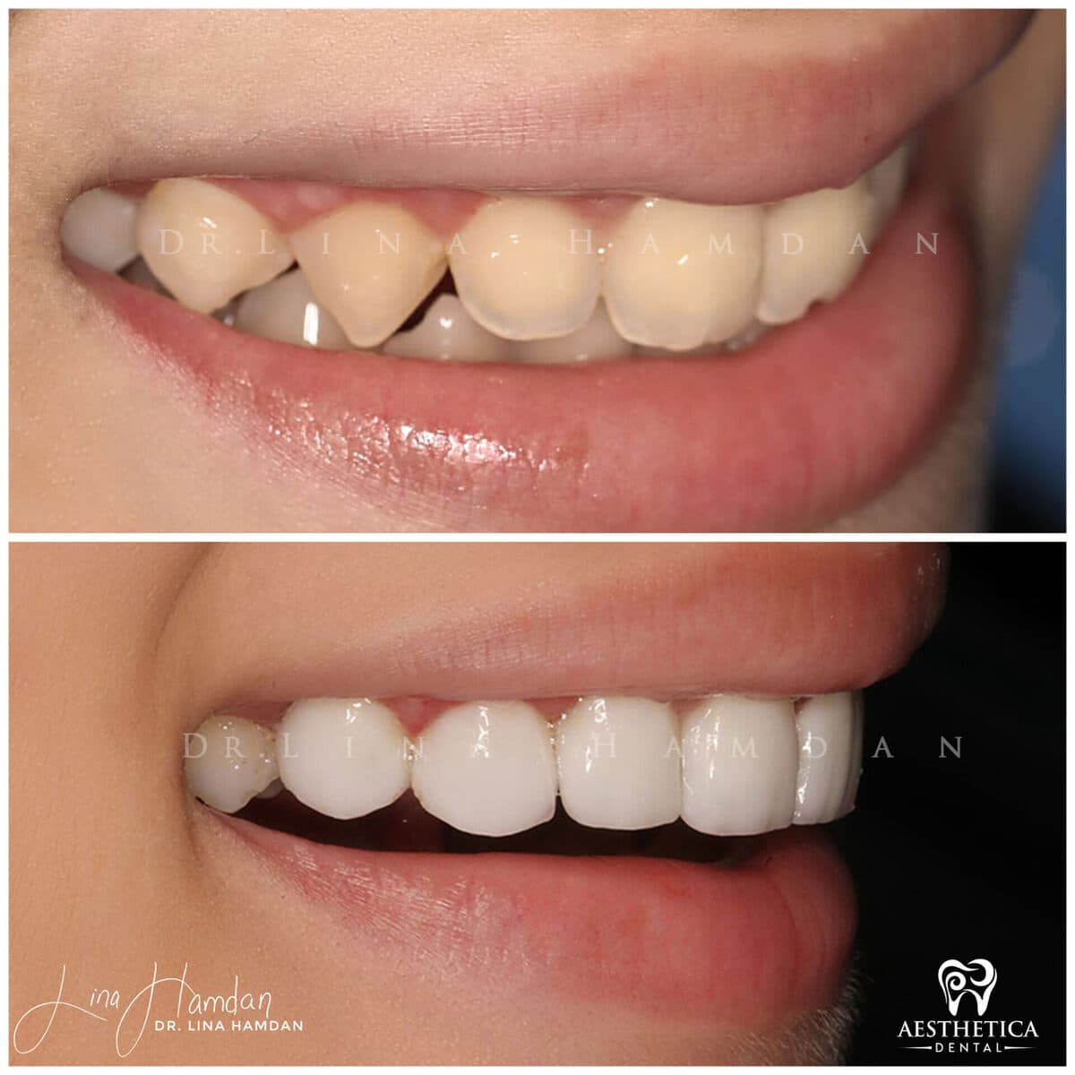 Considered porcelain veneers: anonymous case 38 from Aesthetica Dental Naperville