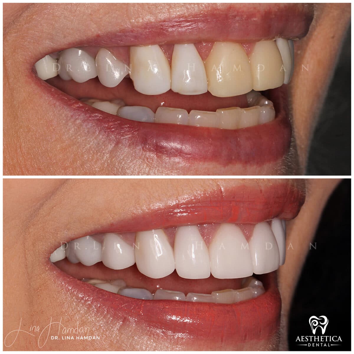 Considered porcelain veneers: anonymous case 41 from Aesthetica Dental Naperville