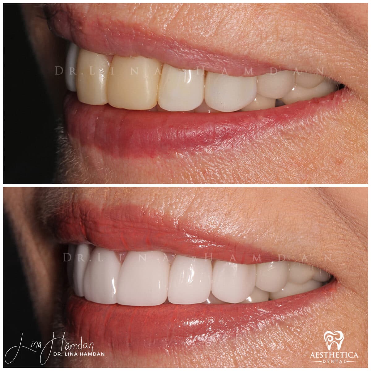 Considered porcelain veneers: anonymous case 47 from Aesthetica Dental Naperville