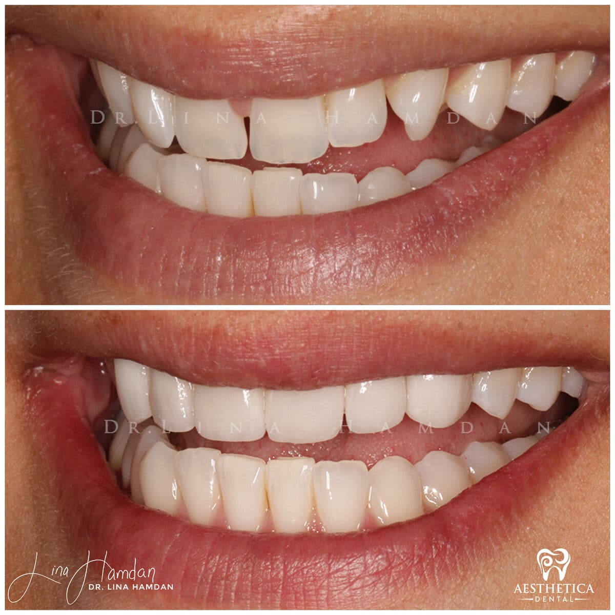 Considered porcelain veneers: anonymous case 50 from Aesthetica Dental Naperville