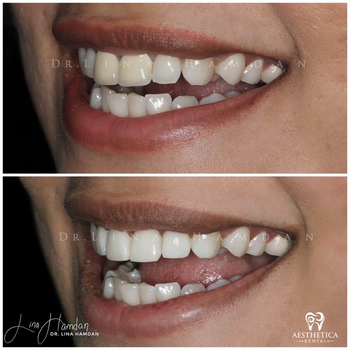 Considered porcelain veneers: anonymous case 52 from Aesthetica Dental Naperville