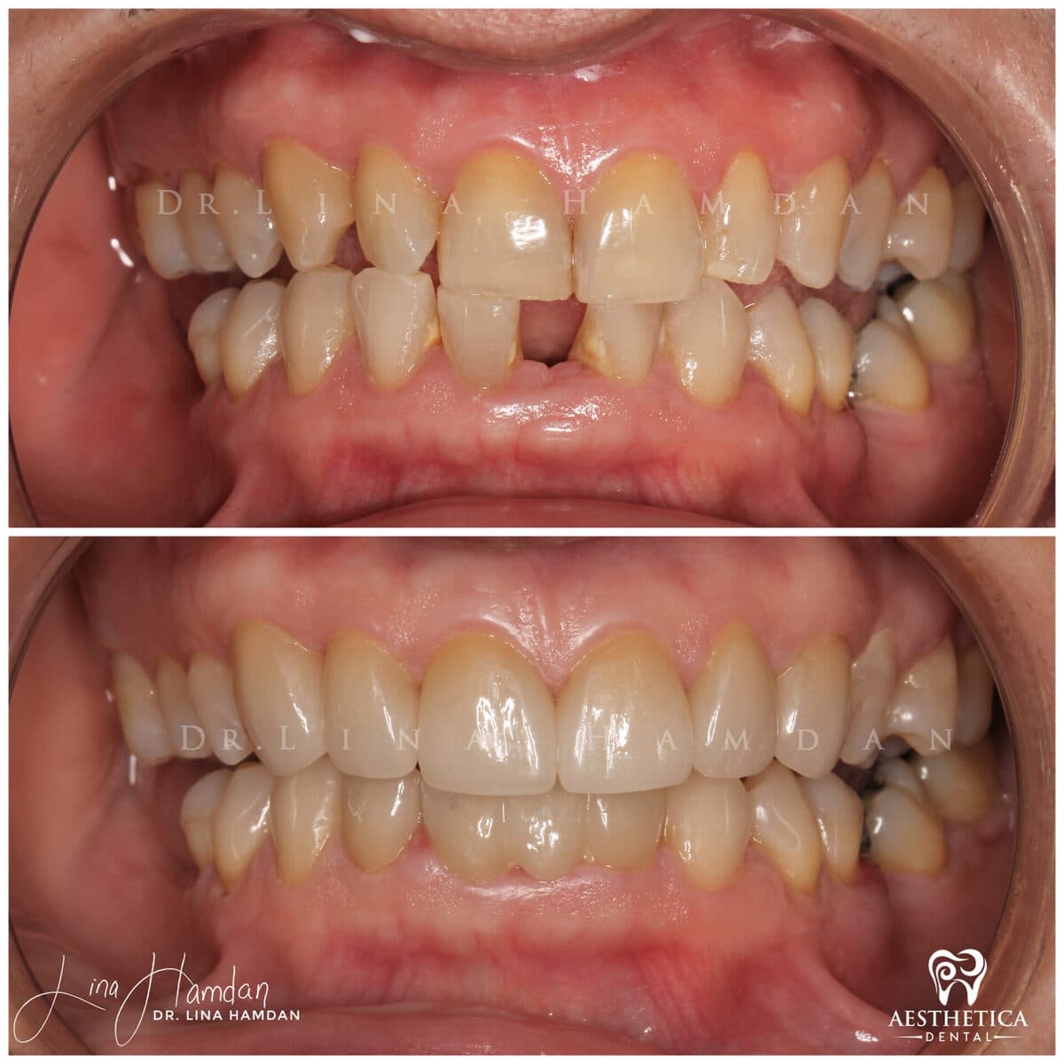 Considered porcelain veneers: anonymous case 56 from Aesthetica Dental Naperville