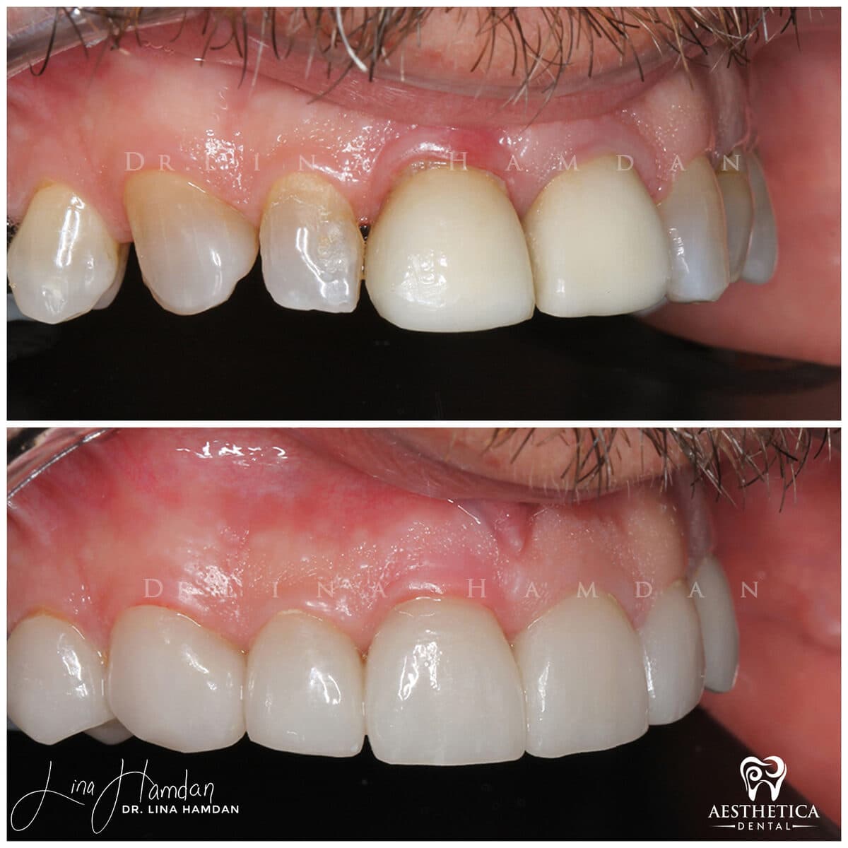 Considered porcelain veneers: anonymous case 60 from Aesthetica Dental Naperville