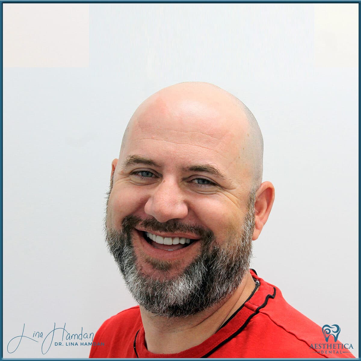 Considered porcelain veneers: anonymous case 65 from Aesthetica Dental Naperville