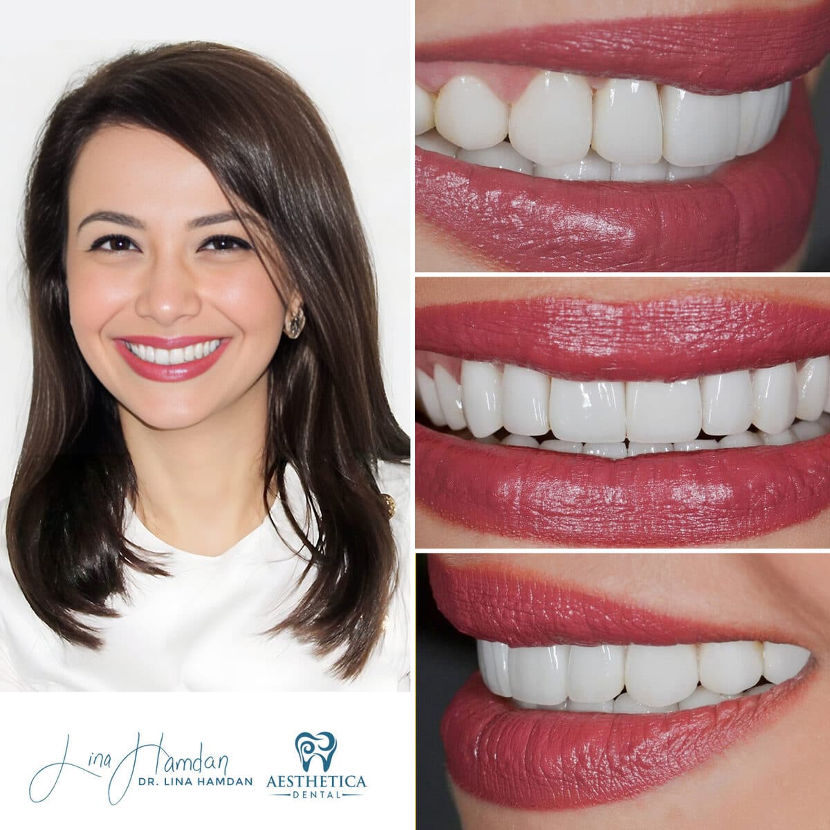 Considered porcelain veneers: anonymous case 69 from Aesthetica Dental Naperville