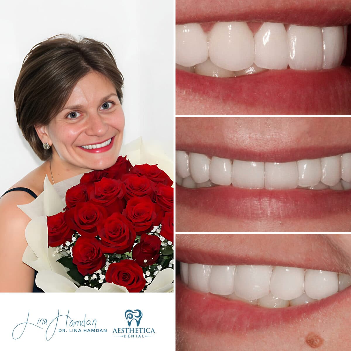 Considered porcelain veneers: anonymous case 70 from Aesthetica Dental Naperville