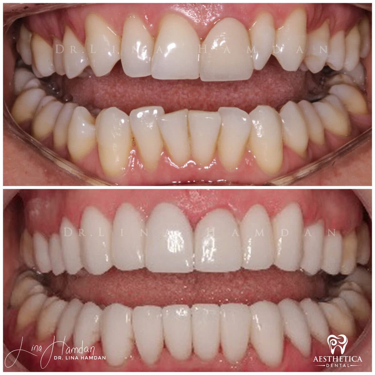 Considered porcelain veneers: anonymous case 76 from Aesthetica Dental Naperville