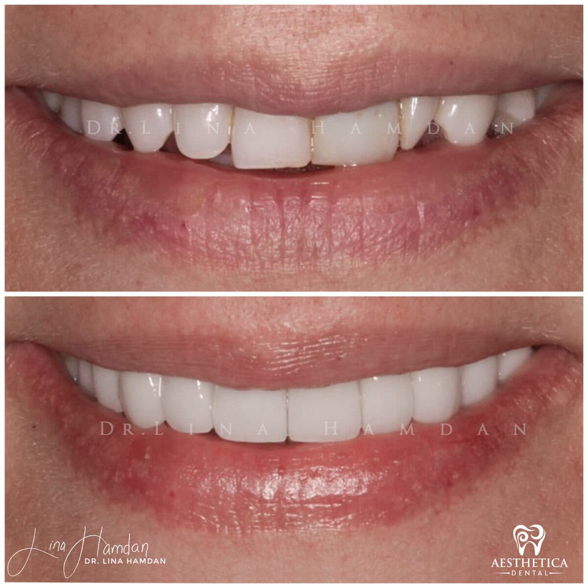 Considered porcelain veneers: anonymous case 81 from Aesthetica Dental Naperville