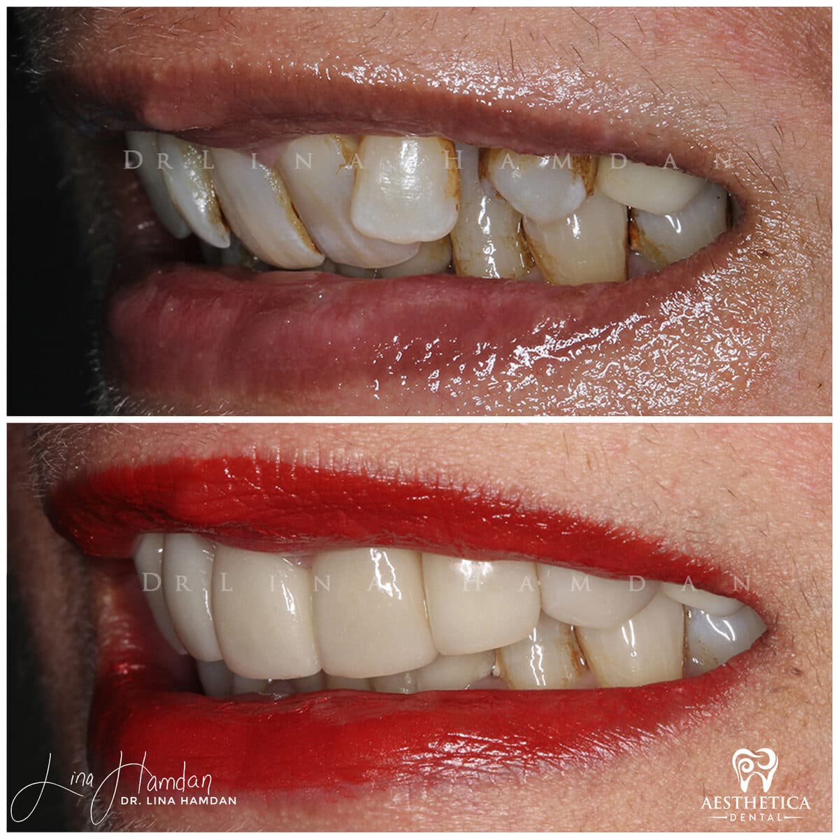 Considered porcelain veneers: anonymous case 84 from Aesthetica Dental Naperville