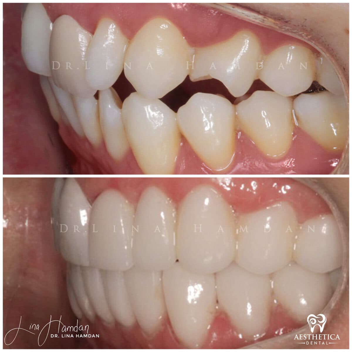Considered porcelain veneers: anonymous case 88 from Aesthetica Dental Naperville