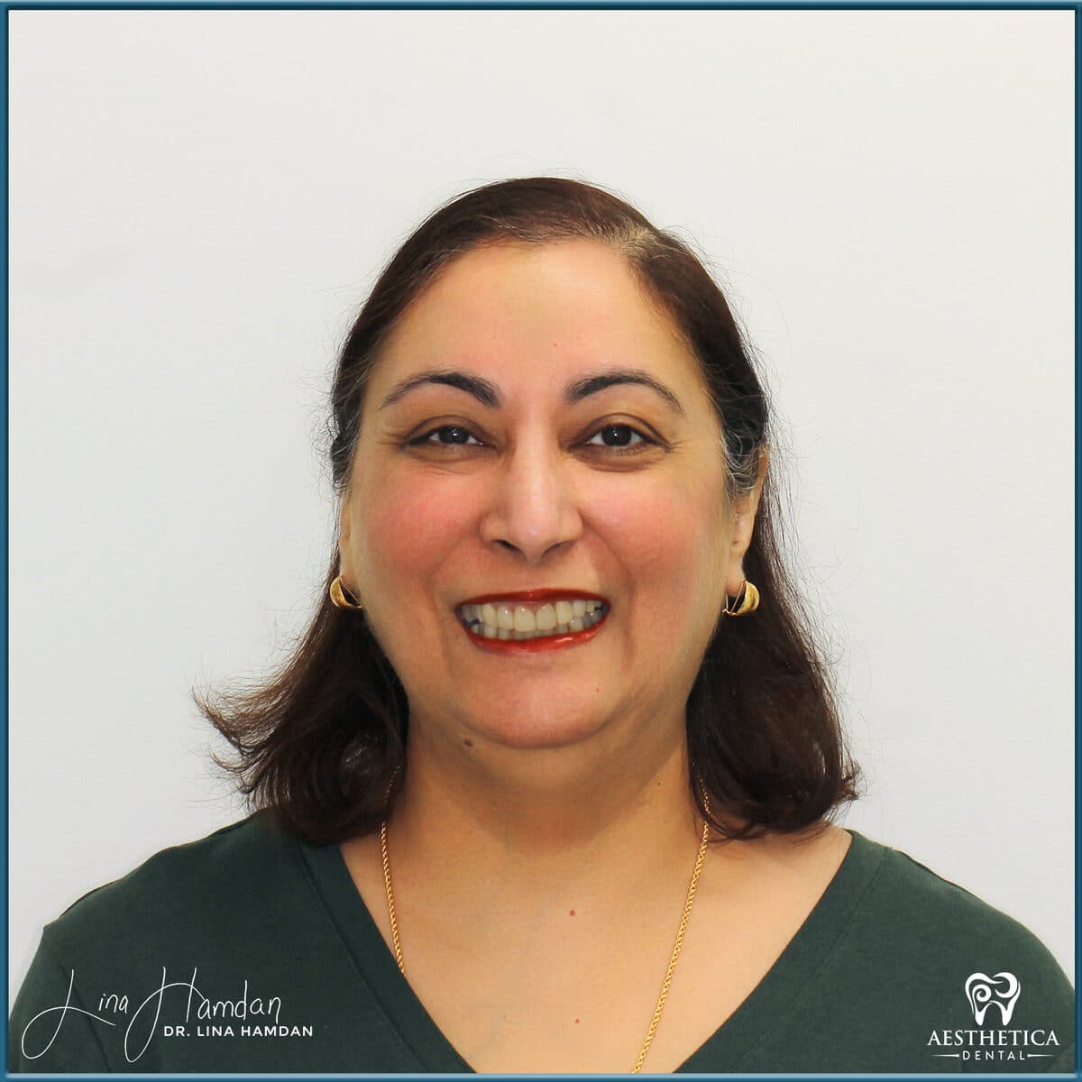 Considered porcelain veneers: anonymous case 90 from Aesthetica Dental Naperville