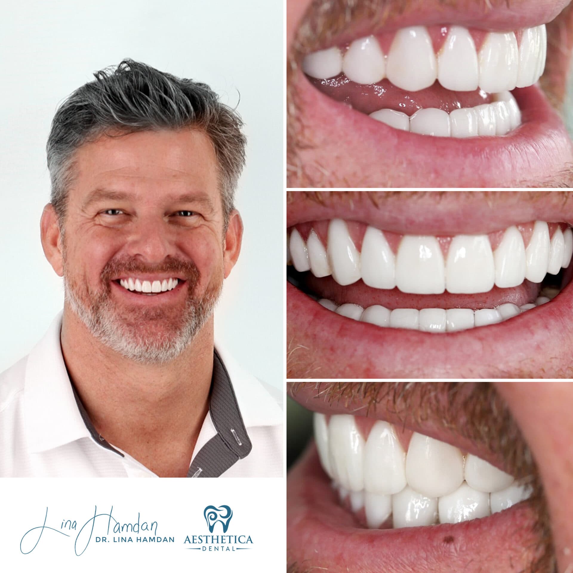 Invisalign result with refinement, anonymous patient at Aesthetica Dental Naperville