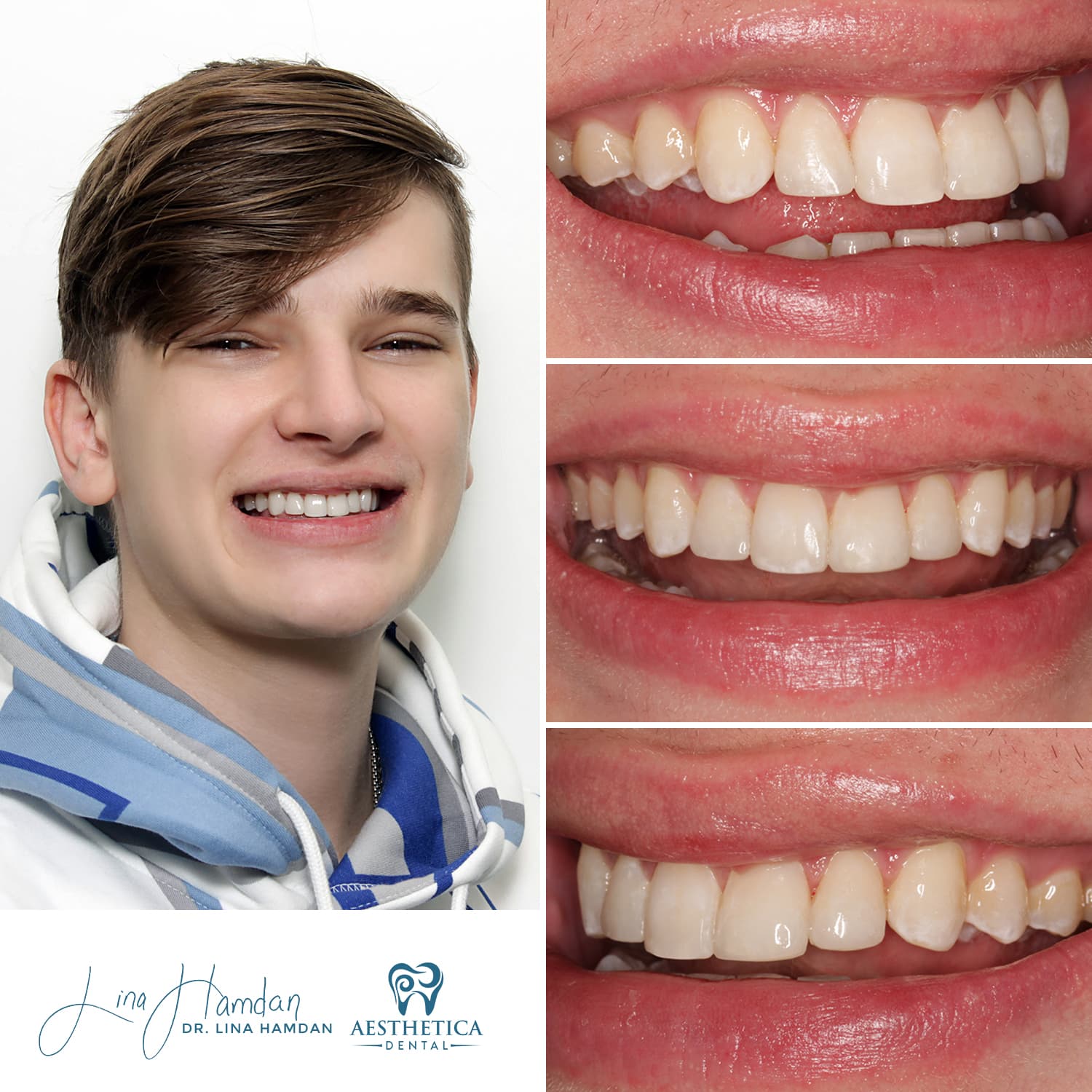 Inman Aligner before and after, anonymous patient at Aesthetica Dental Naperville