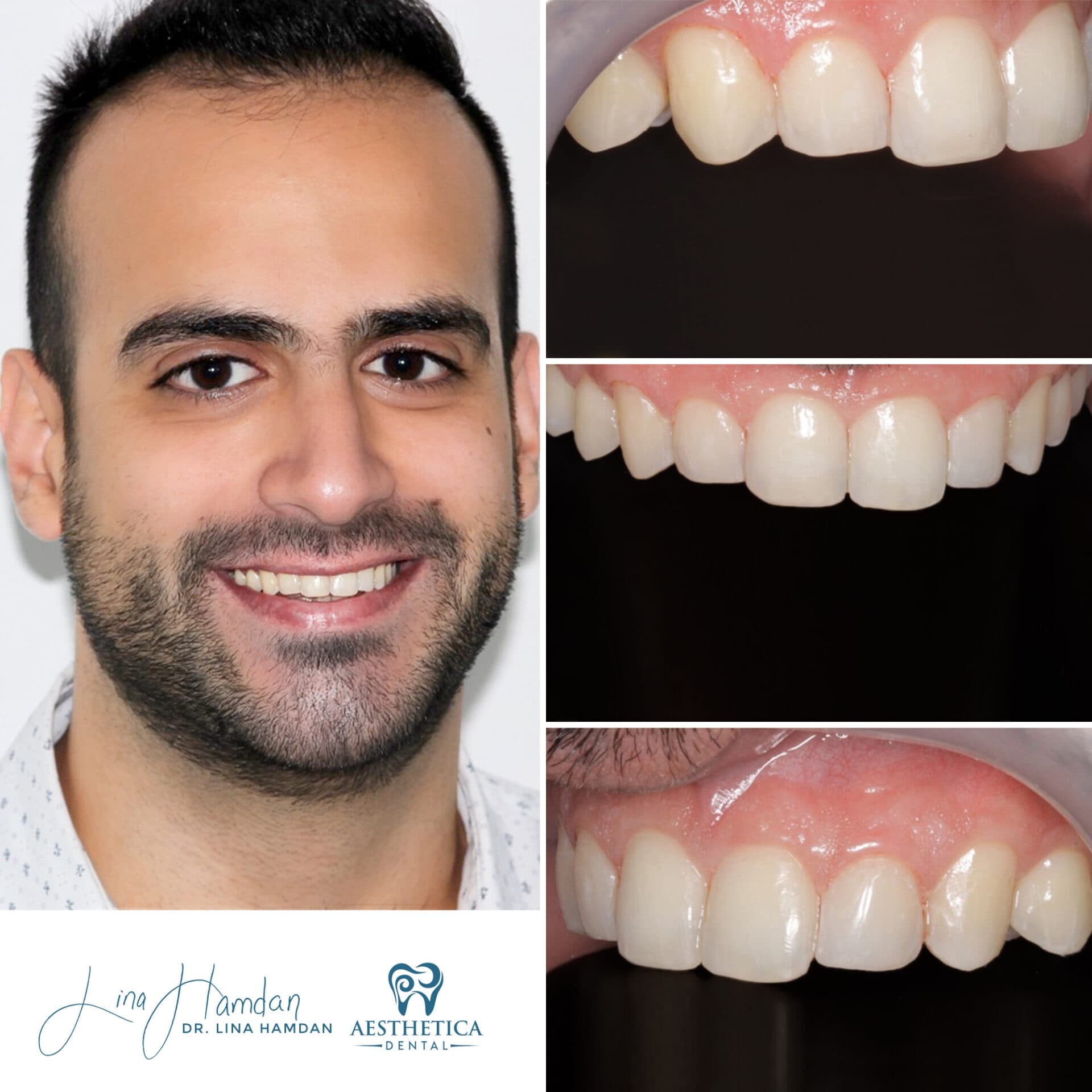 Invisalign clear aligner result, mild crowding case, anonymous patient at Aesthetica Dental Naperville