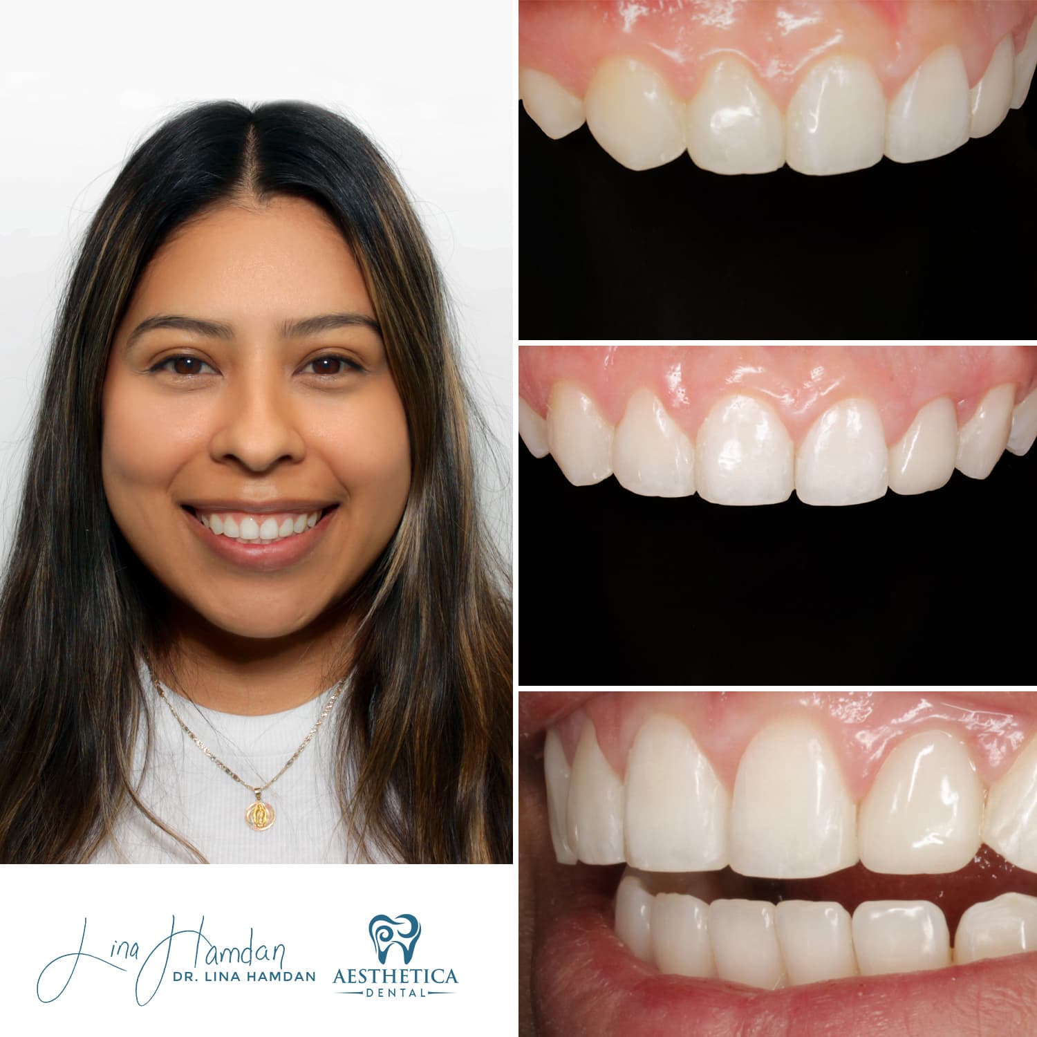 Composite bonding result, single tooth aesthetic repair, anonymous patient at Aesthetica Dental Naperville