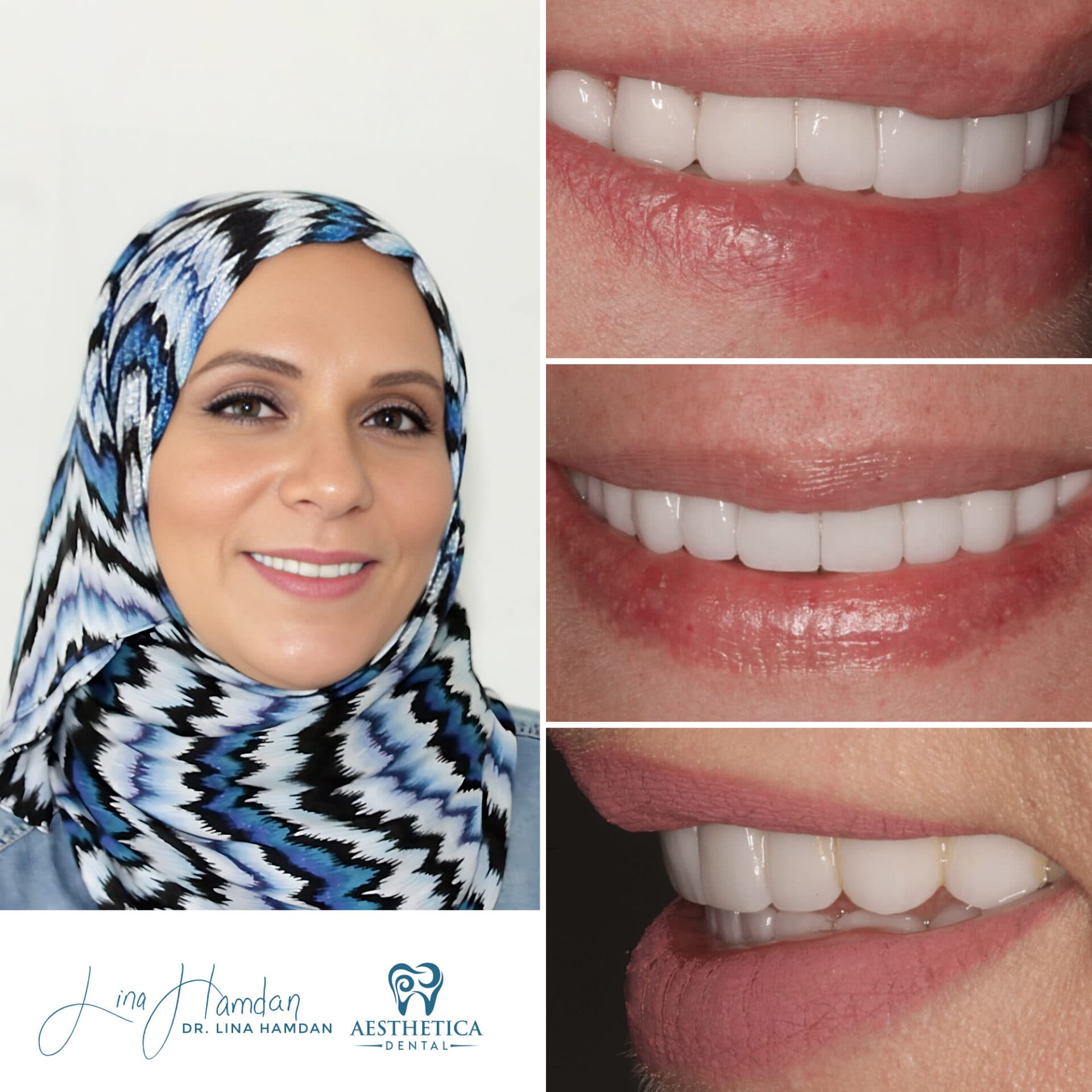 Composite bonding result, peg lateral reshaping, anonymous patient at Aesthetica Dental Naperville
