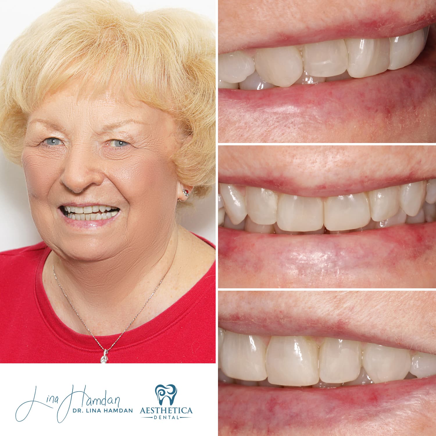 Invisalign result, post-orthodontic relapse correction, anonymous patient at Aesthetica Dental Naperville
