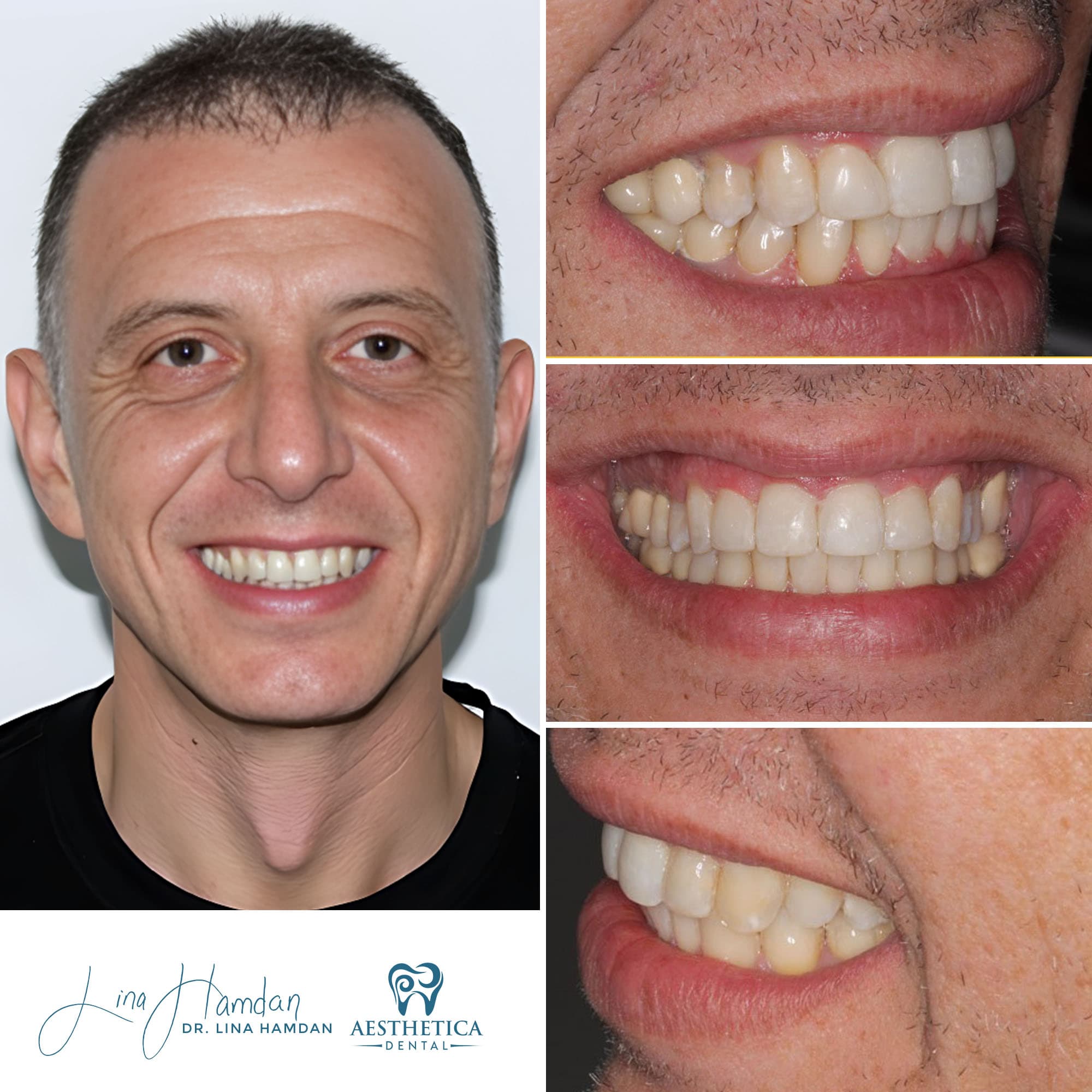 Porcelain veneers result, four-unit anterior case, anonymous patient at Aesthetica Dental Naperville