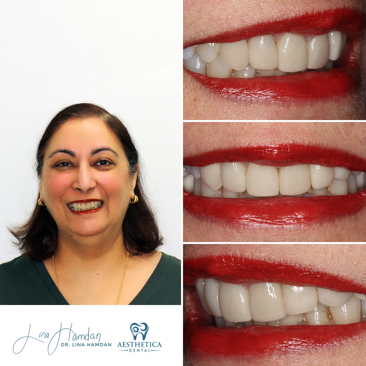 Porcelain veneers result, conservative preparation case, anonymous patient at Aesthetica Dental Naperville