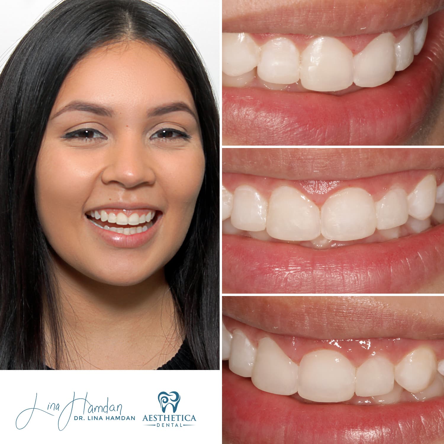 Inman Aligner result, front teeth alignment, anonymous patient at Aesthetica Dental Naperville