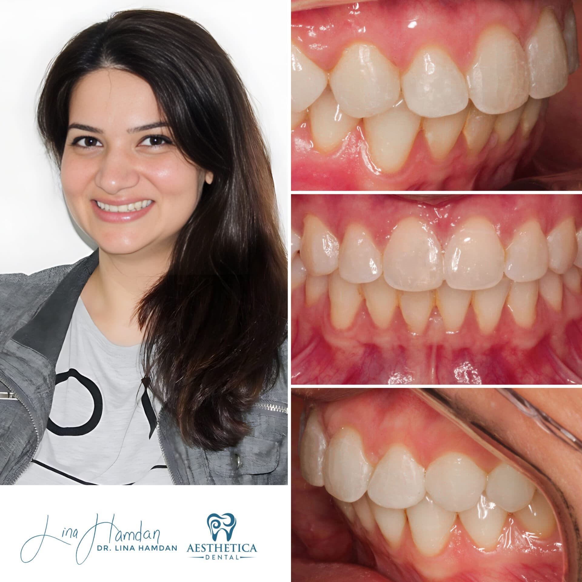 Composite bonding chip repair, anonymous patient at Aesthetica Dental Naperville